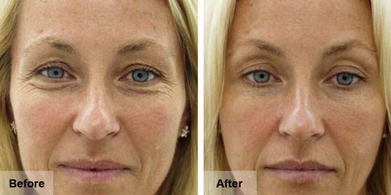 Botox Treatments Hampshire | Andrea Jones Aesthetics